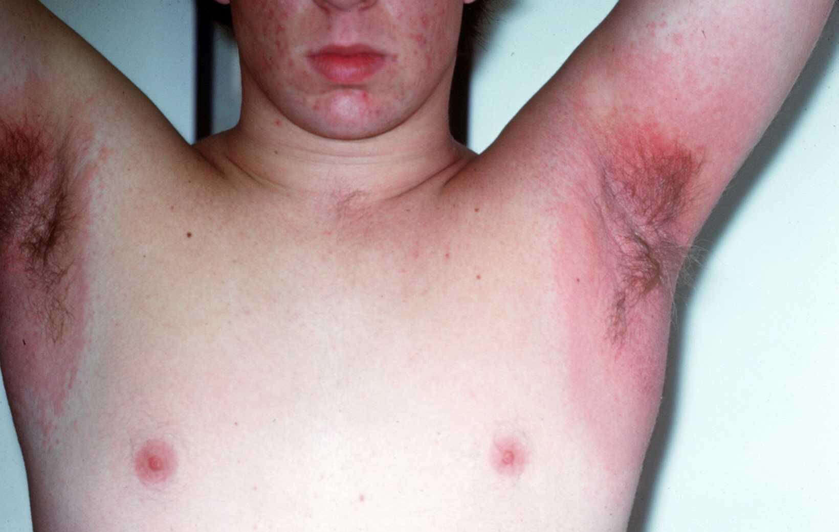 Allergische reactie onder oksel deodorant