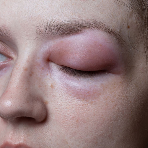 Allergische reactie ooglid