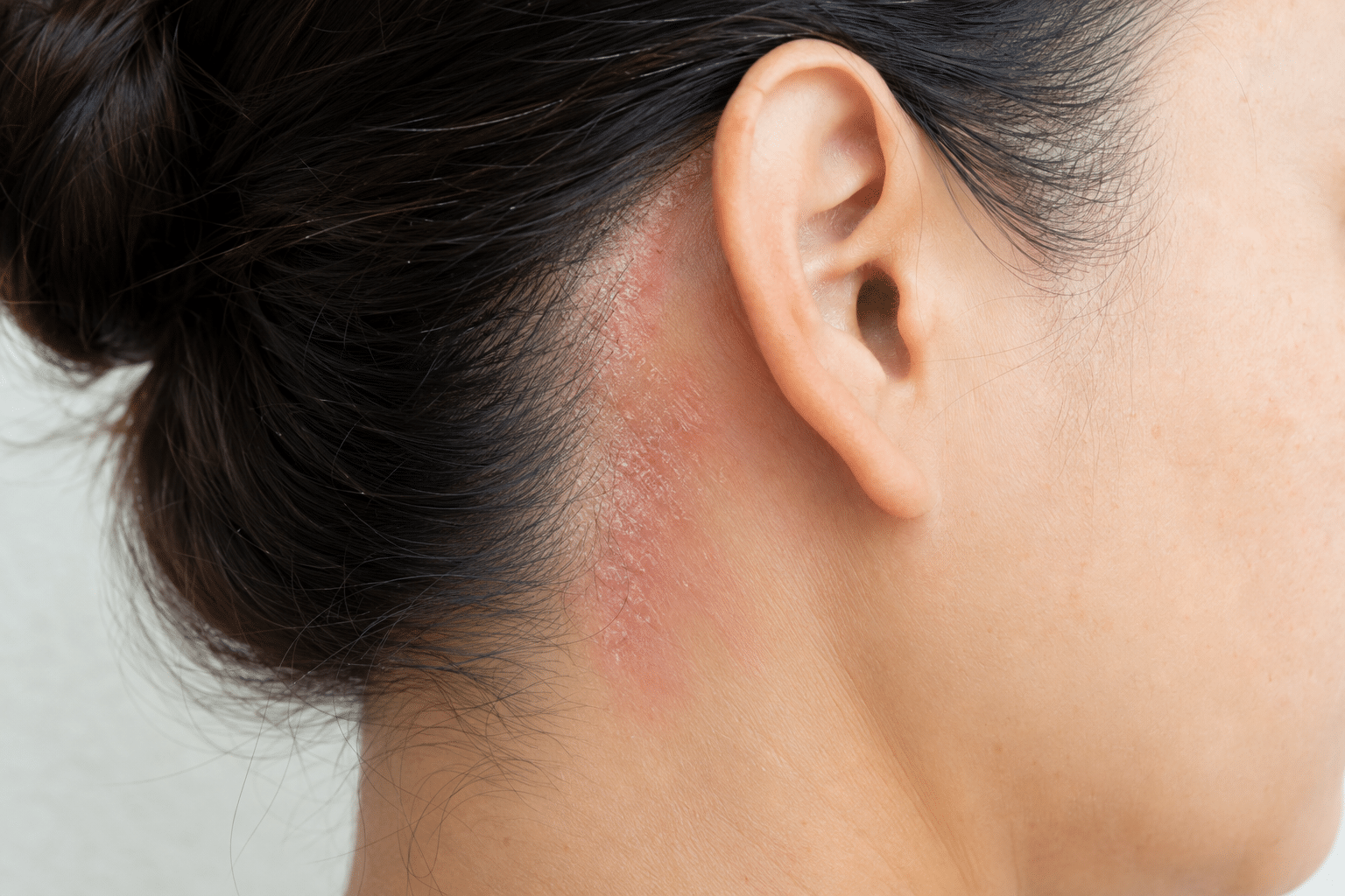 Shampooallergie