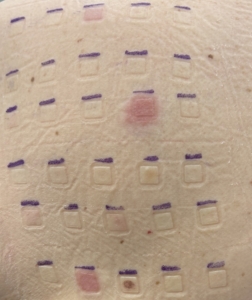 Huidreactie Patchtest