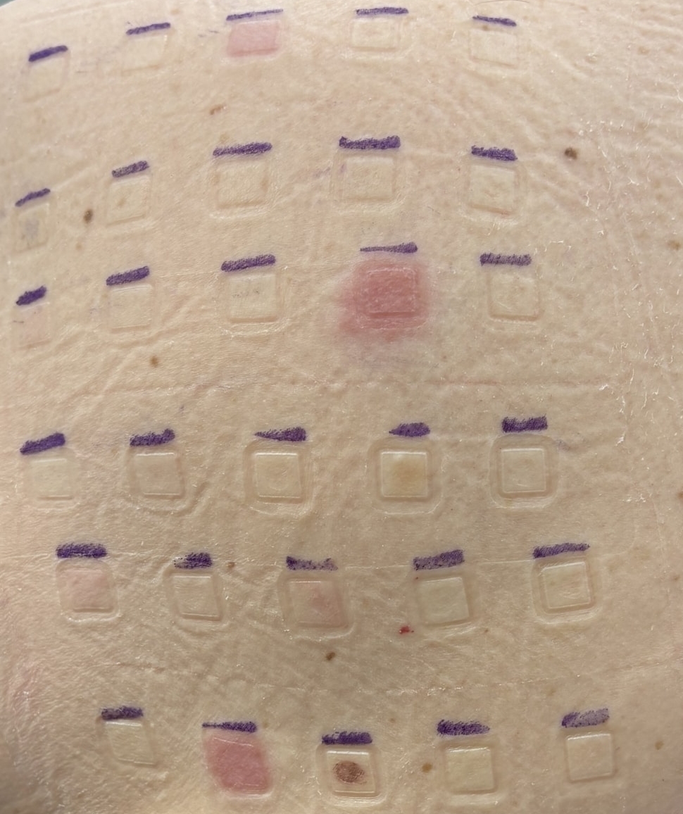Huidreactie Patchtest